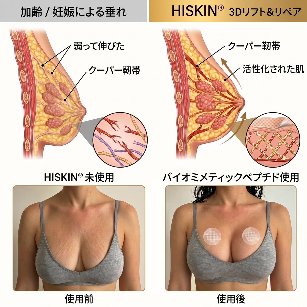 ✨【バストケア新革命】HISKIN® ナノニードル パッチ｜貼るだけ集中アプローチ！ハリ＆ボリューム感UP💃